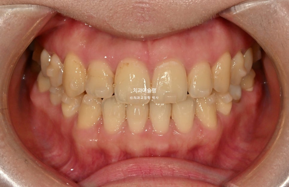 인비절라인 익스프레스 단기 교정 후 무삭제 라미네이트 젤라미 치료