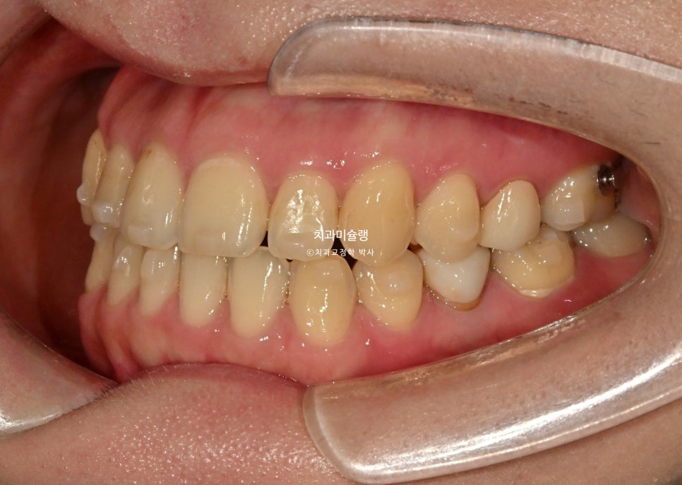 인비절라인 익스프레스 단기 교정 후 무삭제 라미네이트 젤라미 치료