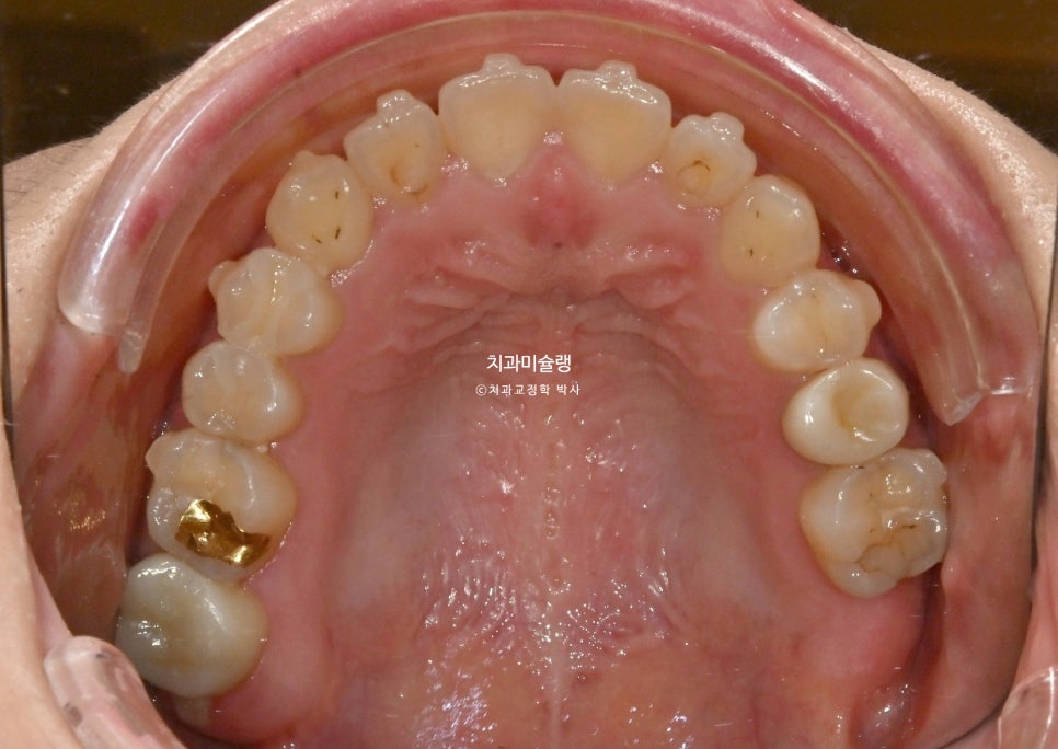 인비절라인 익스프레스 단기 교정 후 무삭제 라미네이트 젤라미 치료