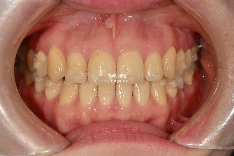 인비절라인 익스프레스 단기 교정 후 무삭제 라미네이트 젤라미 치료