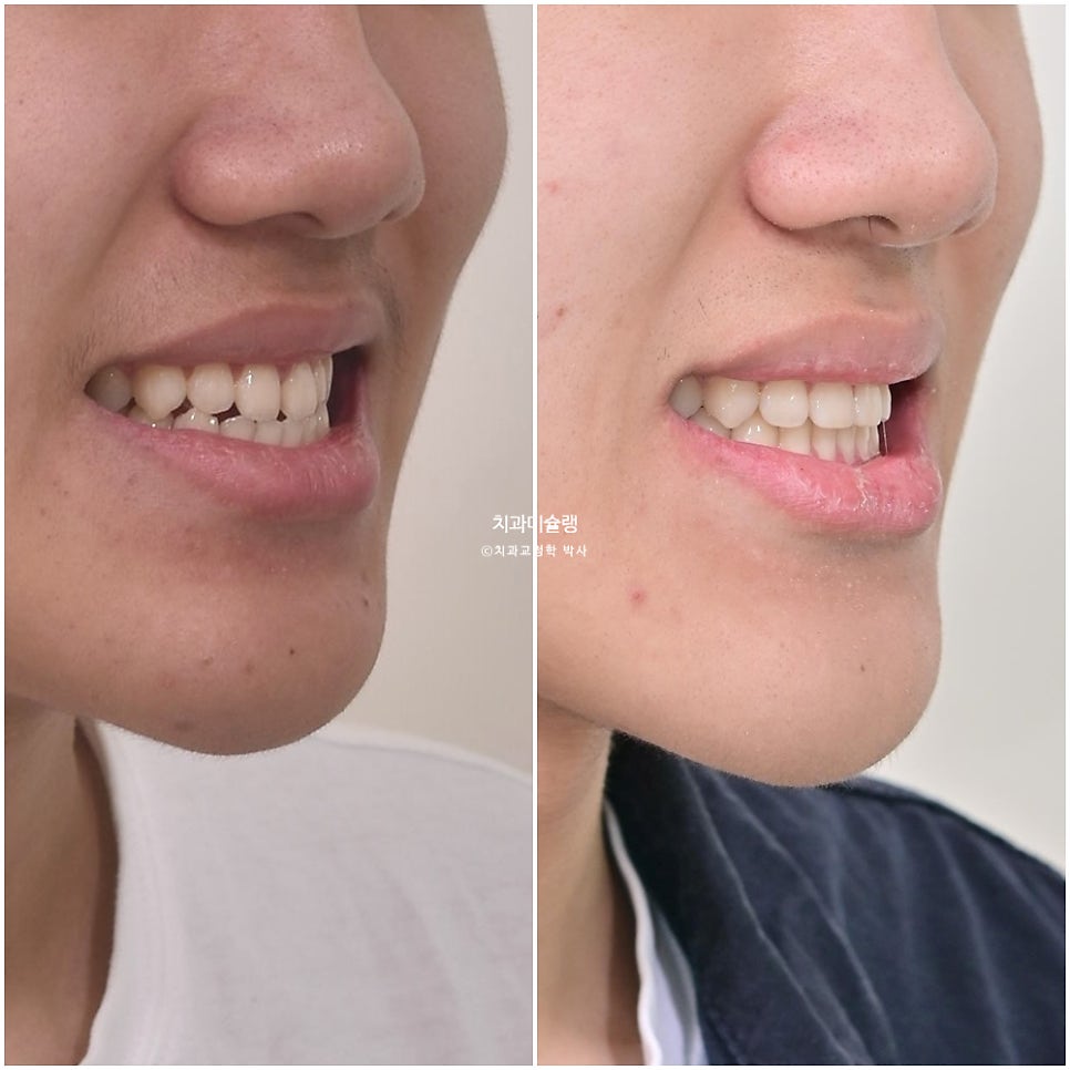 유학생 인비절라인 교정 비발치 비수술 주걱턱 3급 부정교합 절단교합 치료기간 1년 3개월 재제작 0회