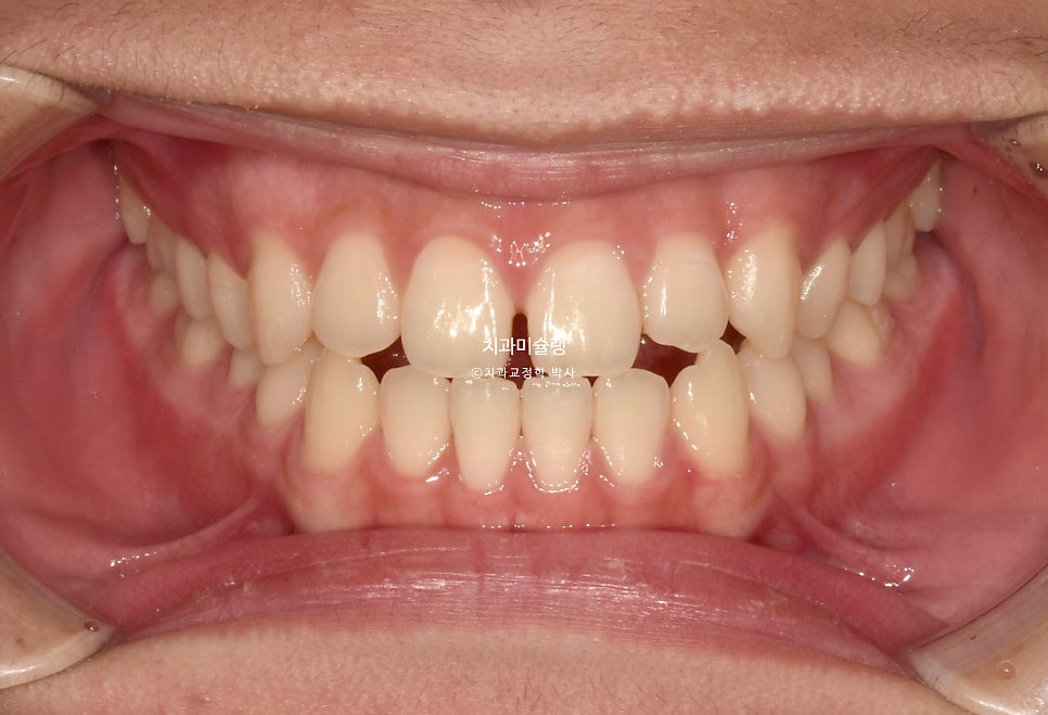 유학생 인비절라인 교정 비발치 비수술 주걱턱 3급 부정교합 절단교합 치료기간 1년 3개월 재제작 0회