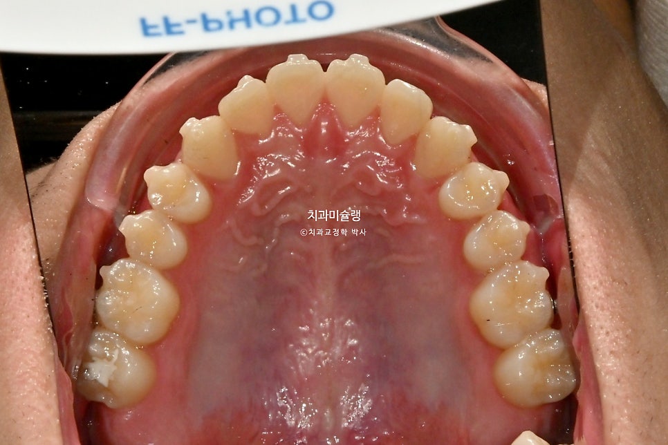 유학생 인비절라인 교정 비발치 비수술 주걱턱 3급 부정교합 절단교합 치료기간 1년 3개월 재제작 0회