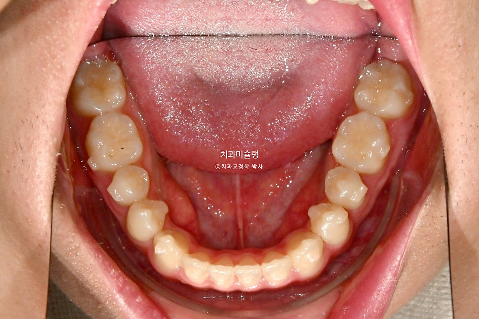 유학생 인비절라인 교정 비발치 비수술 주걱턱 3급 부정교합 절단교합 치료기간 1년 3개월 재제작 0회