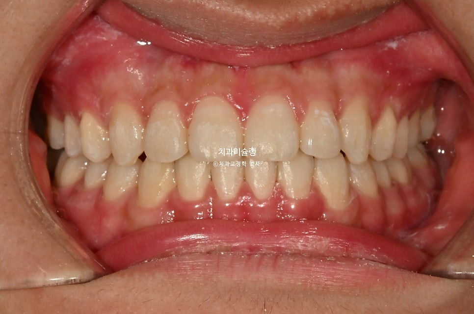유학생 인비절라인 교정 비발치 비수술 주걱턱 3급 부정교합 절단교합 치료기간 1년 3개월 재제작 0회
