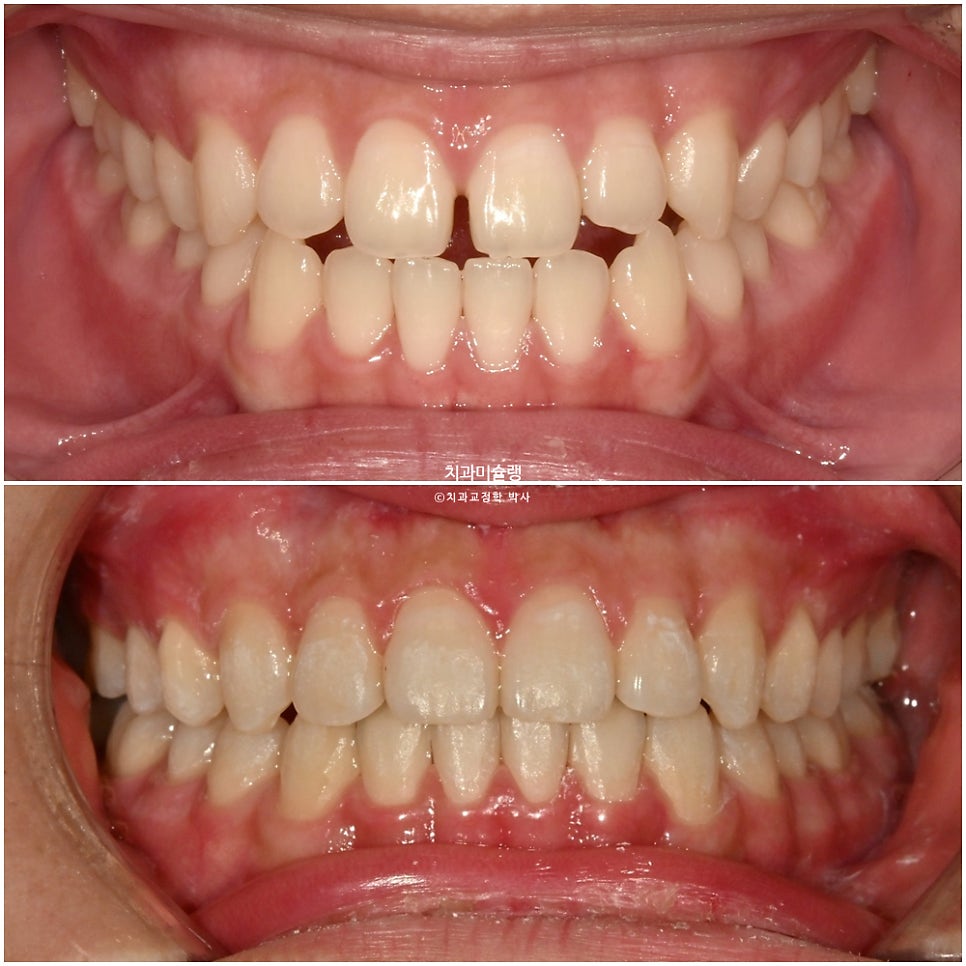 유학생 인비절라인 교정 비발치 비수술 주걱턱 3급 부정교합 절단교합 치료기간 1년 3개월 재제작 0회