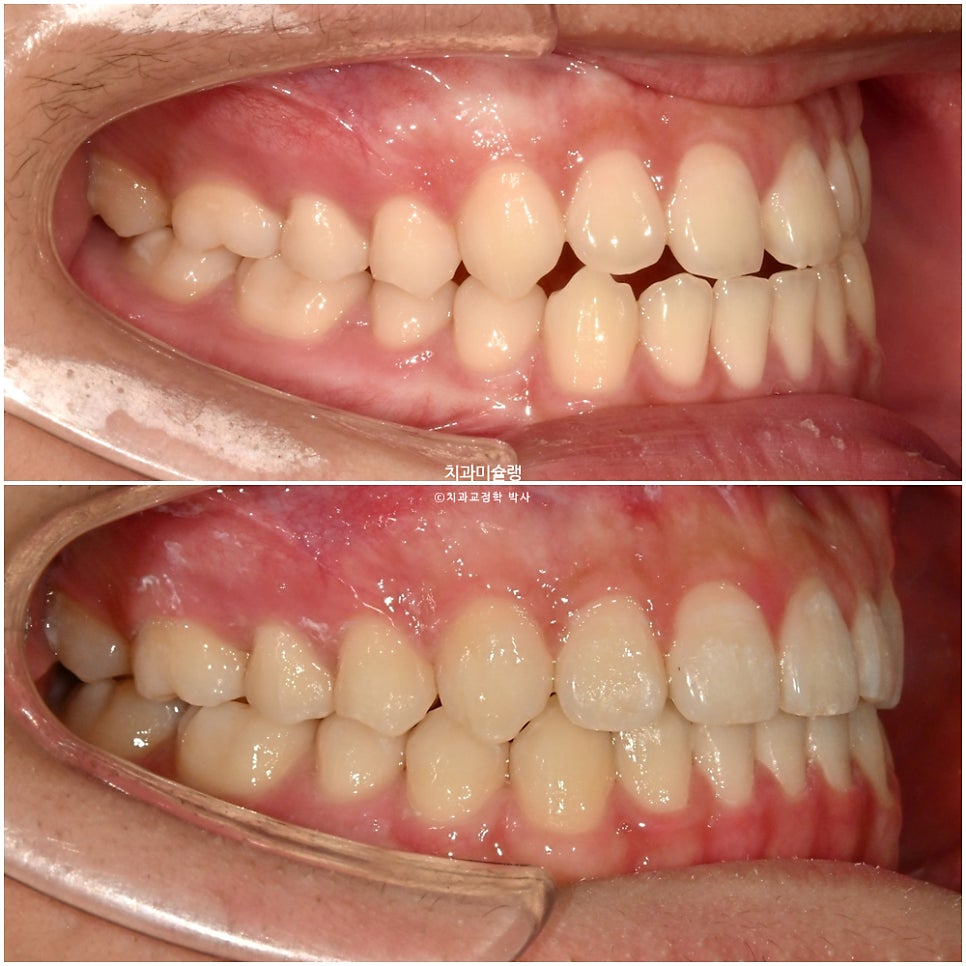 유학생 인비절라인 교정 비발치 비수술 주걱턱 3급 부정교합 절단교합 치료기간 1년 3개월 재제작 0회