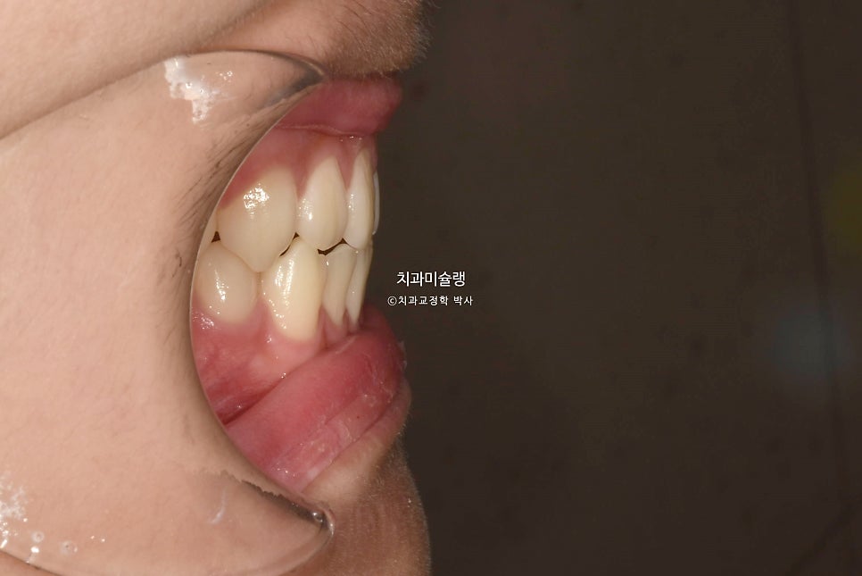 유학생 인비절라인 교정 비발치 비수술 주걱턱 3급 부정교합 절단교합 치료기간 1년 3개월 재제작 0회