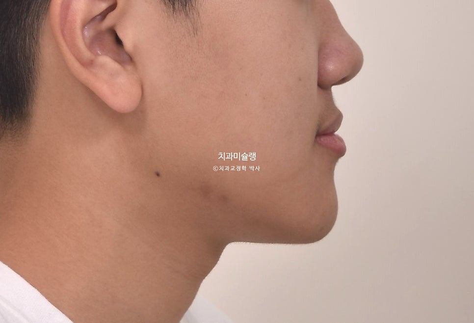 유학생 인비절라인 교정 비발치 비수술 주걱턱 3급 부정교합 절단교합 치료기간 1년 3개월 재제작 0회