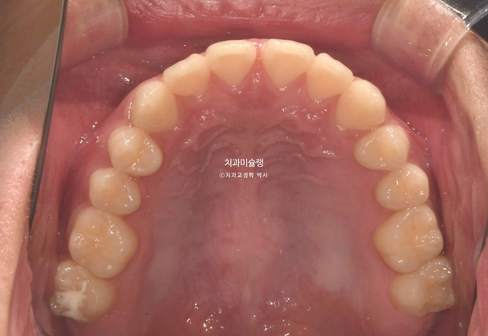 유학생 인비절라인 교정 비발치 비수술 주걱턱 3급 부정교합 절단교합 치료기간 1년 3개월 재제작 0회