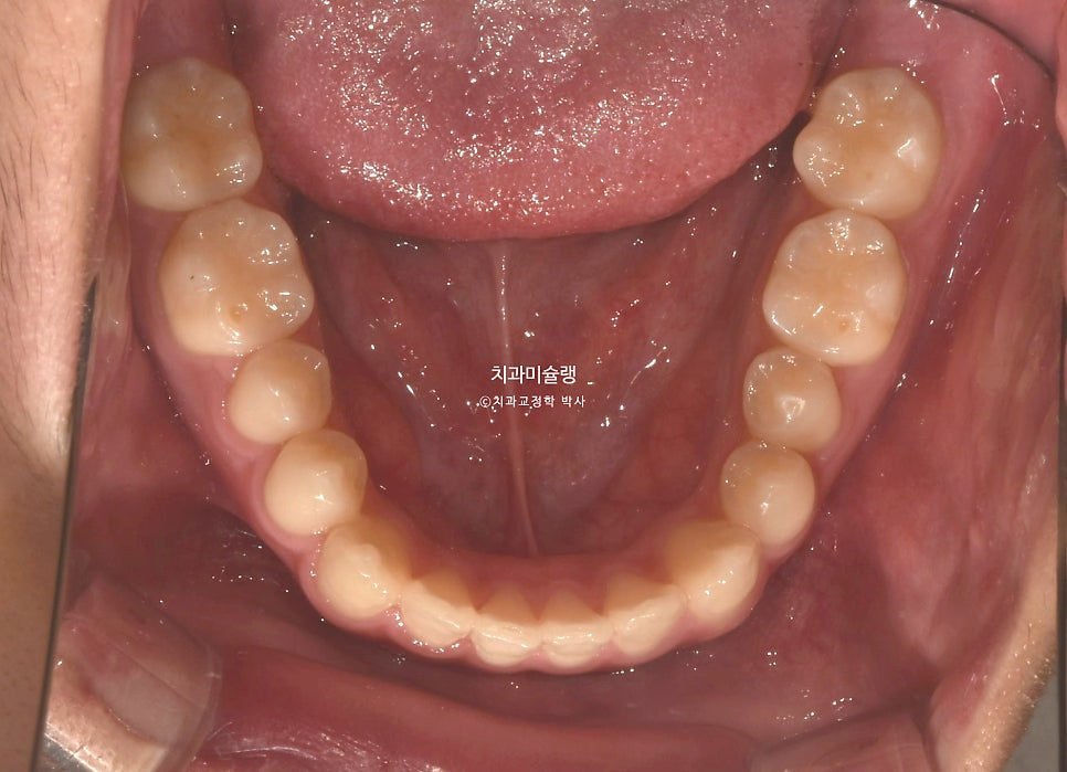 유학생 인비절라인 교정 비발치 비수술 주걱턱 3급 부정교합 절단교합 치료기간 1년 3개월 재제작 0회
