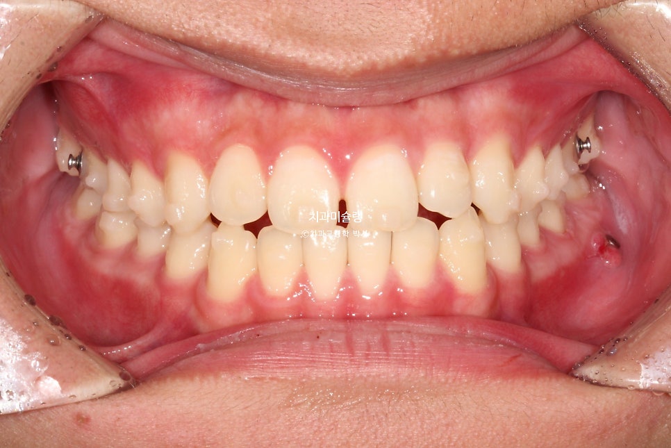 유학생 인비절라인 교정 비발치 비수술 주걱턱 3급 부정교합 절단교합 치료기간 1년 3개월 재제작 0회