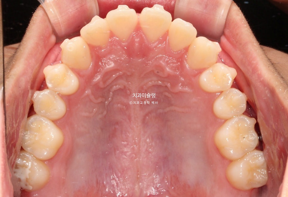 유학생 인비절라인 교정 비발치 비수술 주걱턱 3급 부정교합 절단교합 치료기간 1년 3개월 재제작 0회