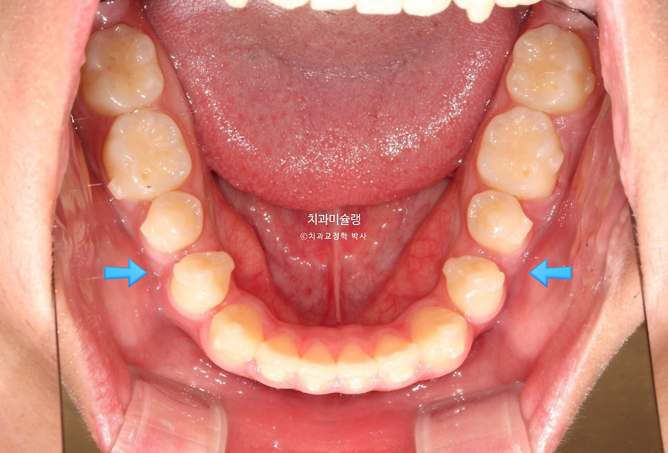 유학생 인비절라인 교정 비발치 비수술 주걱턱 3급 부정교합 절단교합 치료기간 1년 3개월 재제작 0회