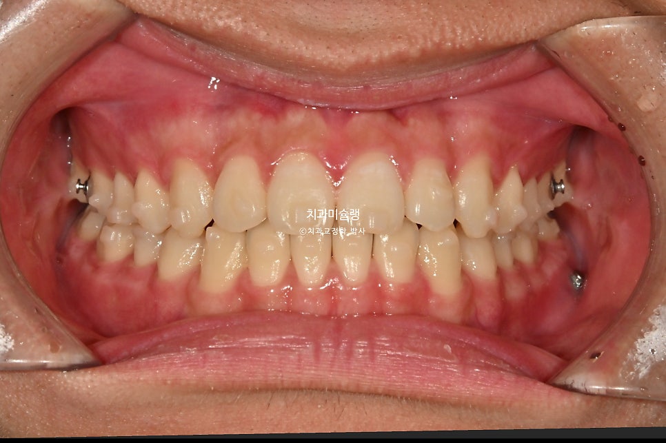 유학생 인비절라인 교정 비발치 비수술 주걱턱 3급 부정교합 절단교합 치료기간 1년 3개월 재제작 0회