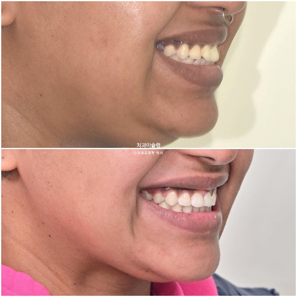 보철 돌출입 발치교정 재교정 클리피씨 임플란트를 위한 정출된 치아 함입 교정 치료기간 2년 5개월