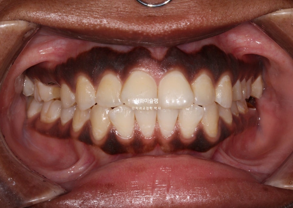 보철 돌출입 발치교정 재교정 클리피씨 임플란트를 위한 정출된 치아 함입 교정 치료기간 2년 5개월