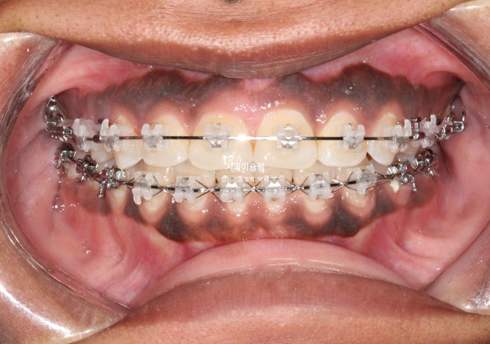 보철 돌출입 발치교정 재교정 클리피씨 임플란트를 위한 정출된 치아 함입 교정 치료기간 2년 5개월