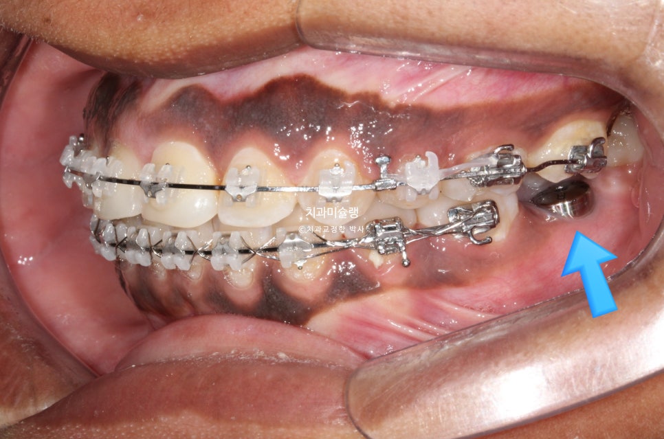 보철 돌출입 발치교정 재교정 클리피씨 임플란트를 위한 정출된 치아 함입 교정 치료기간 2년 5개월