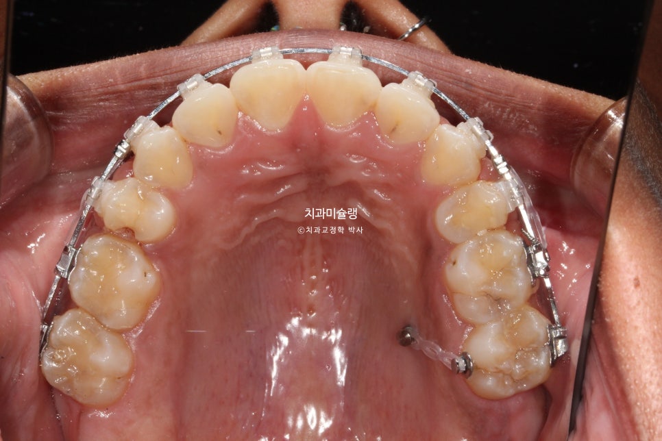 보철 돌출입 발치교정 재교정 클리피씨 임플란트를 위한 정출된 치아 함입 교정 치료기간 2년 5개월