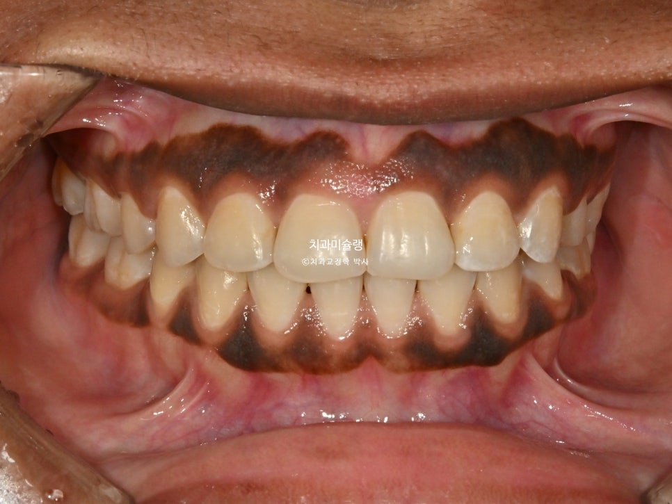 보철 돌출입 발치교정 재교정 클리피씨 임플란트를 위한 정출된 치아 함입 교정 치료기간 2년 5개월