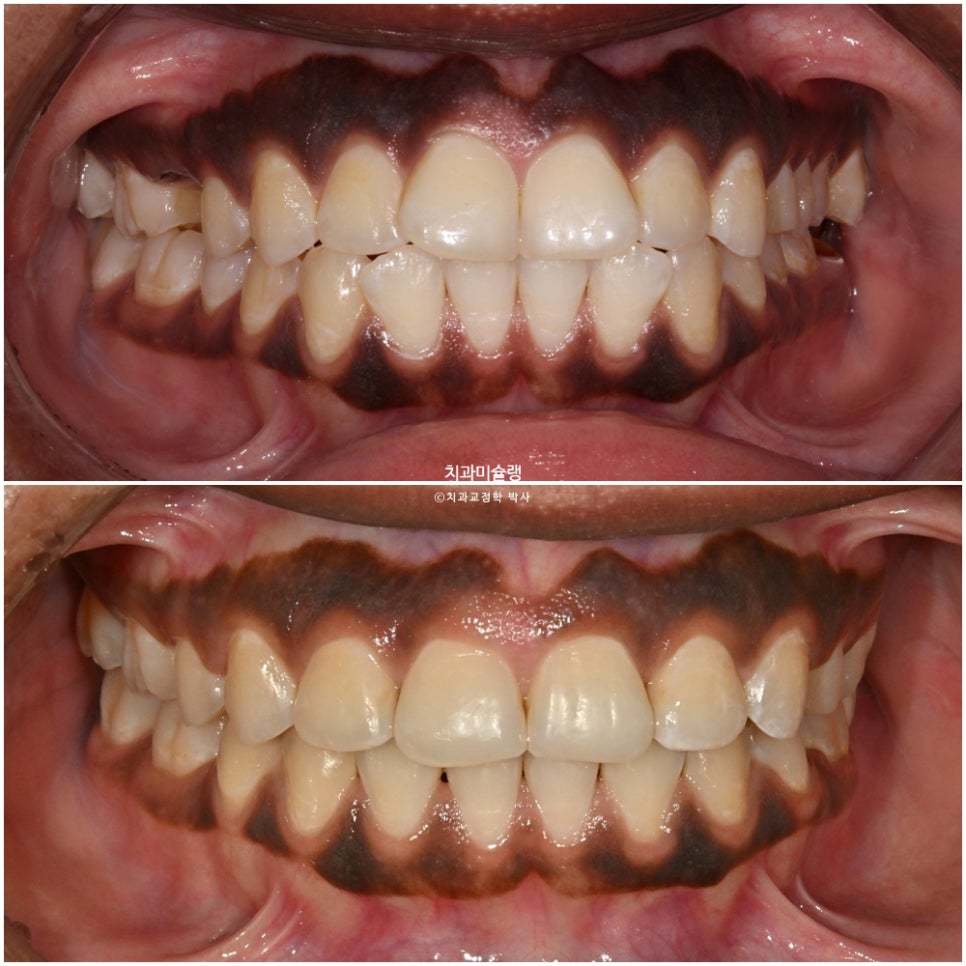보철 돌출입 발치교정 재교정 클리피씨 임플란트를 위한 정출된 치아 함입 교정 치료기간 2년 5개월