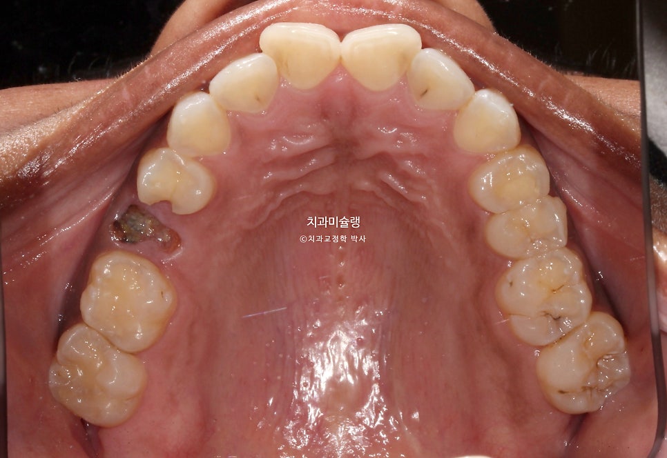 보철 돌출입 발치교정 재교정 클리피씨 임플란트를 위한 정출된 치아 함입 교정 치료기간 2년 5개월