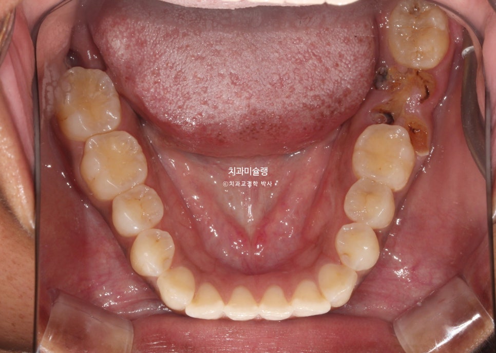 보철 돌출입 발치교정 재교정 클리피씨 임플란트를 위한 정출된 치아 함입 교정 치료기간 2년 5개월
