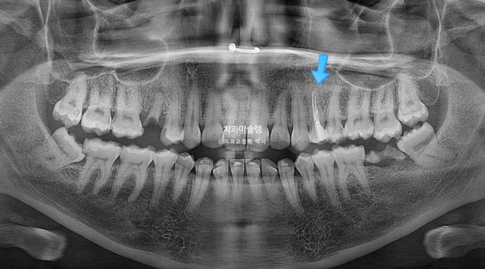 보철 돌출입 발치교정 재교정 클리피씨 임플란트를 위한 정출된 치아 함입 교정 치료기간 2년 5개월