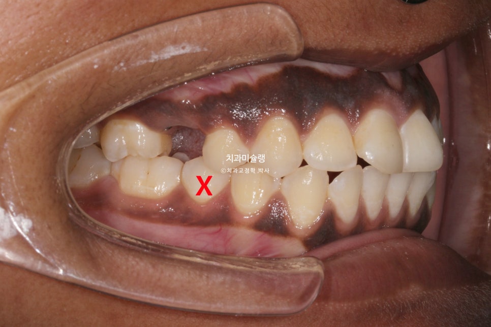 보철 돌출입 발치교정 재교정 클리피씨 임플란트를 위한 정출된 치아 함입 교정 치료기간 2년 5개월