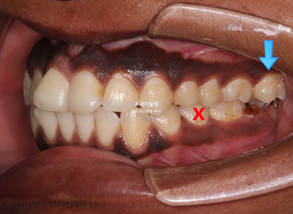 보철 돌출입 발치교정 재교정 클리피씨 임플란트를 위한 정출된 치아 함입 교정 치료기간 2년 5개월