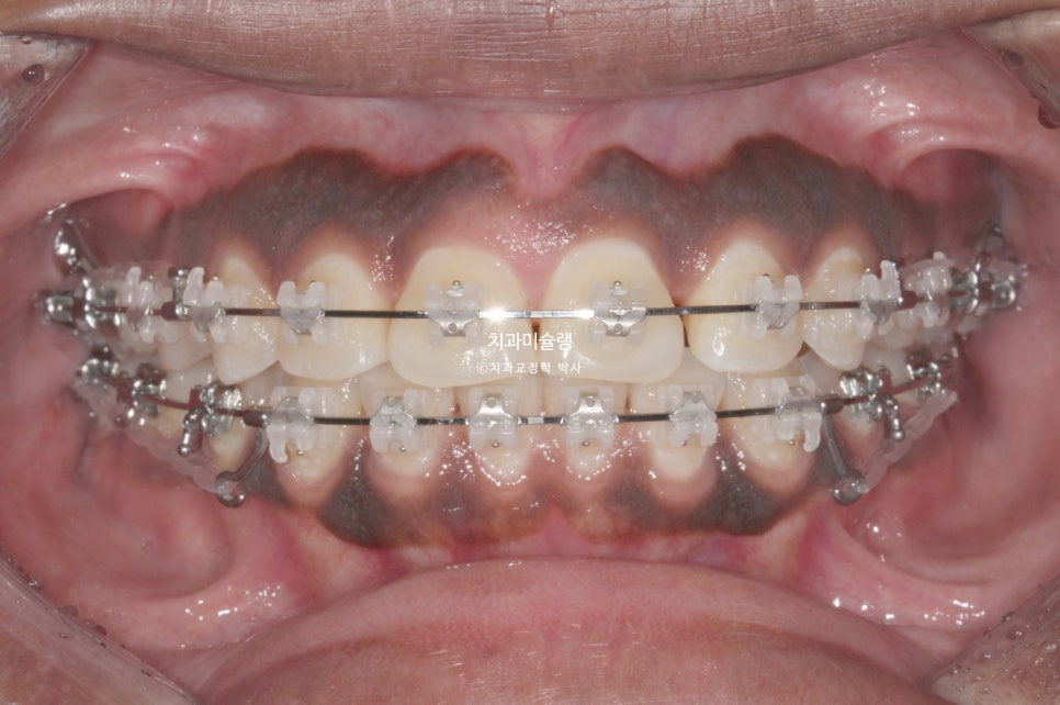 보철 돌출입 발치교정 재교정 클리피씨 임플란트를 위한 정출된 치아 함입 교정 치료기간 2년 5개월