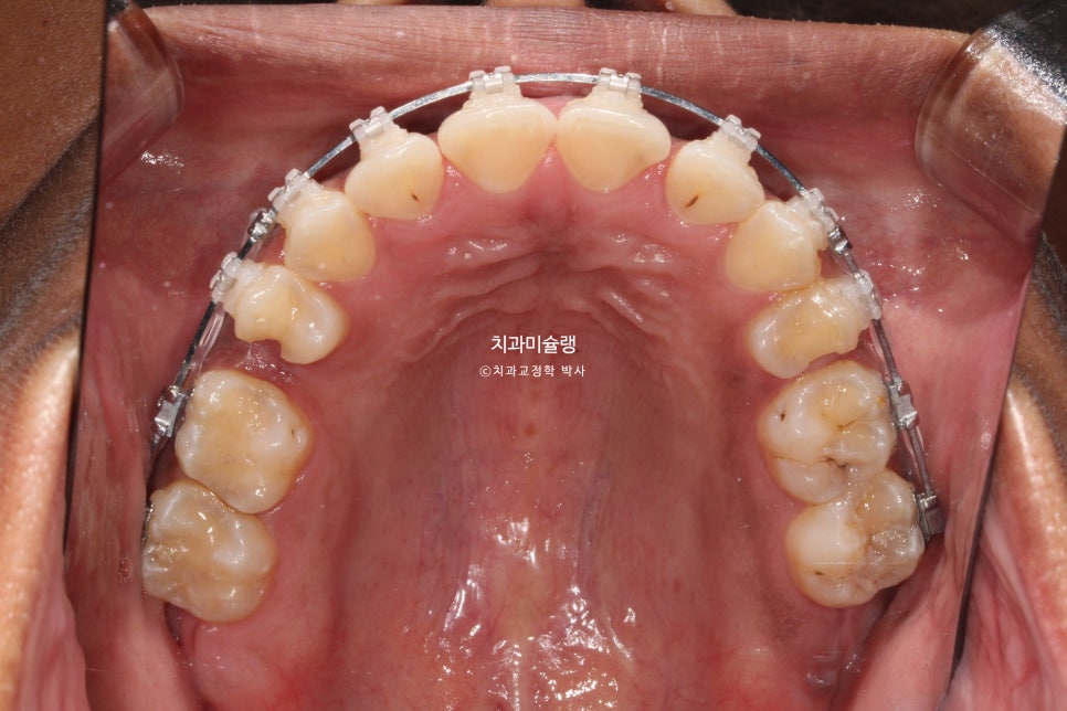 보철 돌출입 발치교정 재교정 클리피씨 임플란트를 위한 정출된 치아 함입 교정 치료기간 2년 5개월