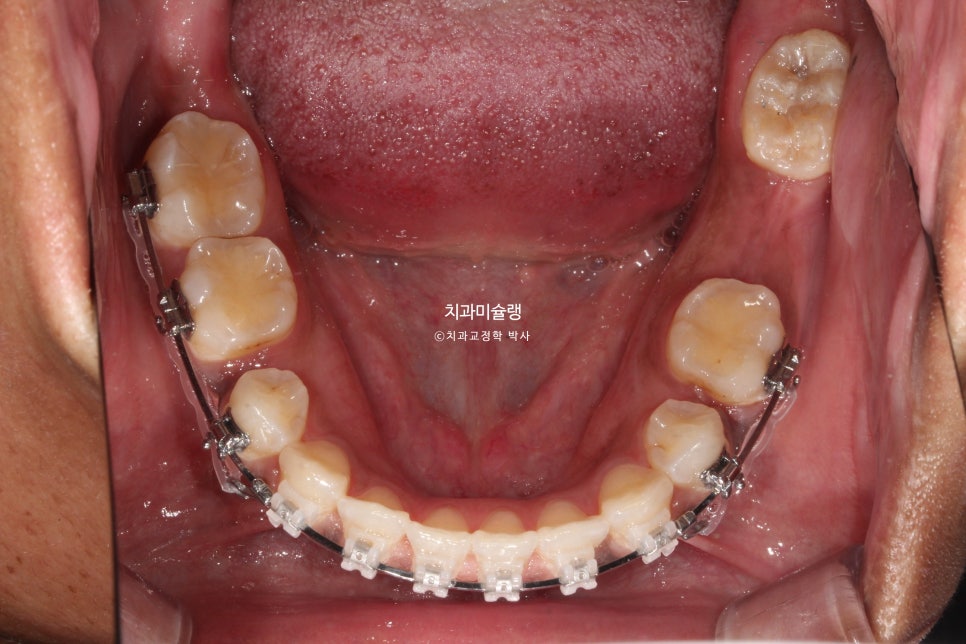 보철 돌출입 발치교정 재교정 클리피씨 임플란트를 위한 정출된 치아 함입 교정 치료기간 2년 5개월