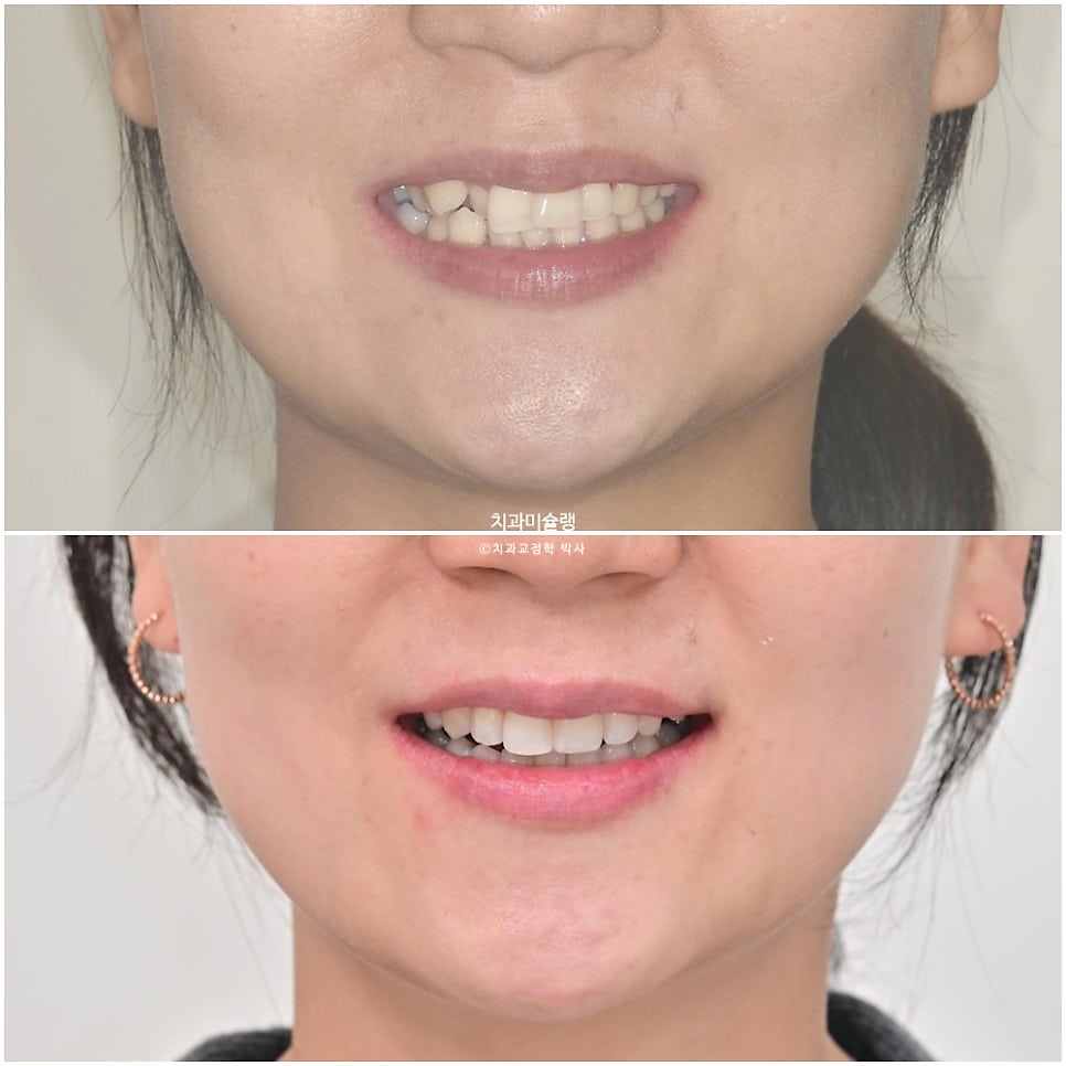 30대 긴 인중과 얇은 입술, 덧니 발치 교정 인비절라인 치료기간 2년 4개월 재제작 1회