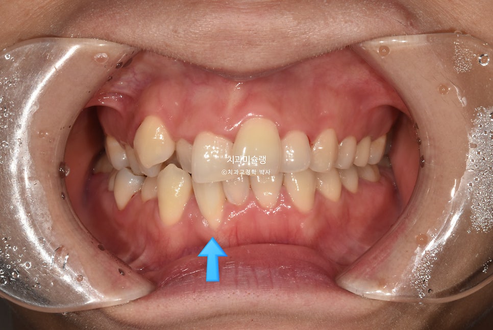 30대 긴 인중과 얇은 입술, 덧니 발치 교정 인비절라인 치료기간 2년 4개월 재제작 1회