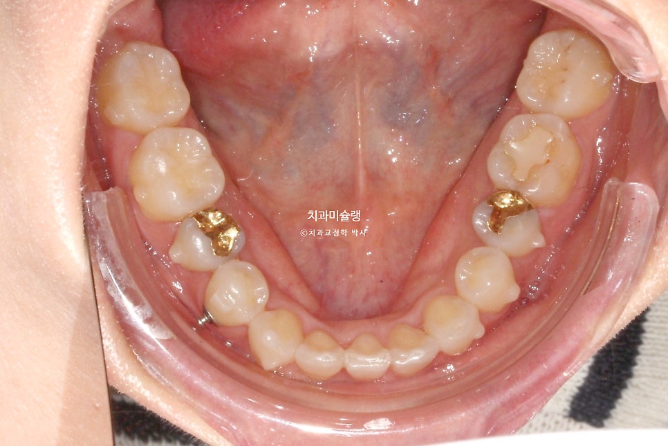 30대 긴 인중과 얇은 입술, 덧니 발치 교정 인비절라인 치료기간 2년 4개월 재제작 1회