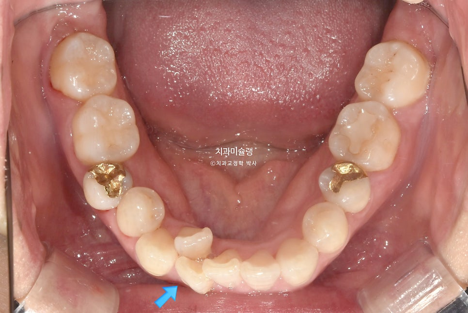 30대 긴 인중과 얇은 입술, 덧니 발치 교정 인비절라인 치료기간 2년 4개월 재제작 1회