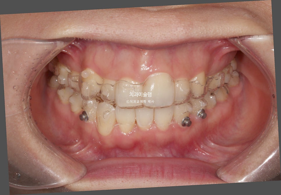 30대 긴 인중과 얇은 입술, 덧니 발치 교정 인비절라인 치료기간 2년 4개월 재제작 1회