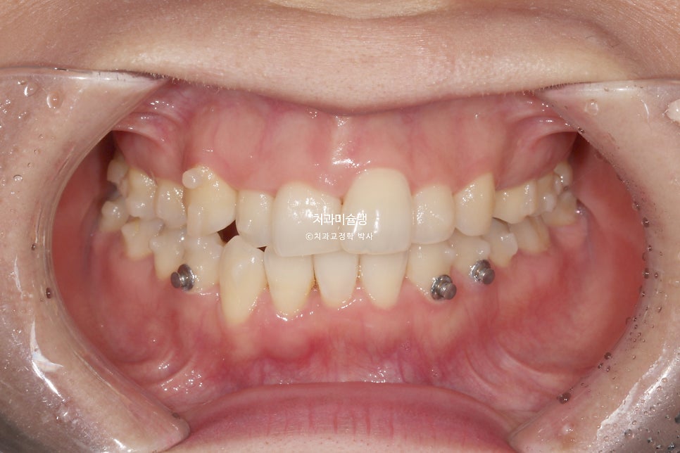30대 긴 인중과 얇은 입술, 덧니 발치 교정 인비절라인 치료기간 2년 4개월 재제작 1회