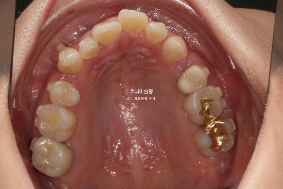 30대 긴 인중과 얇은 입술, 덧니 발치 교정 인비절라인 치료기간 2년 4개월 재제작 1회