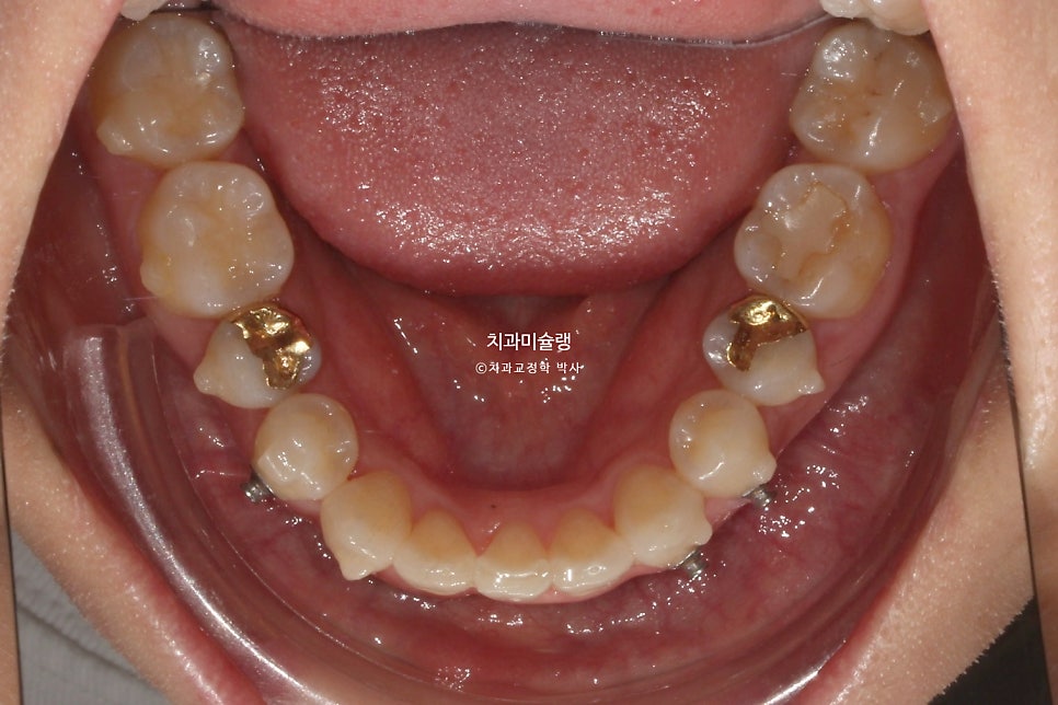 30대 긴 인중과 얇은 입술, 덧니 발치 교정 인비절라인 치료기간 2년 4개월 재제작 1회