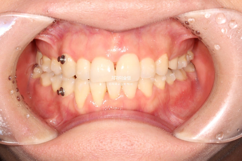 30대 긴 인중과 얇은 입술, 덧니 발치 교정 인비절라인 치료기간 2년 4개월 재제작 1회