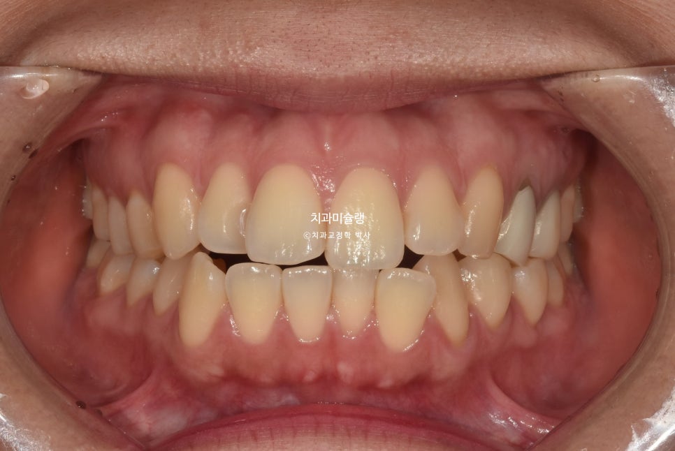 돌출입 발치교정 개방교합 무턱 재교정 인비절라인 입술부전증 치료기간 2년8개월 재제작 2회