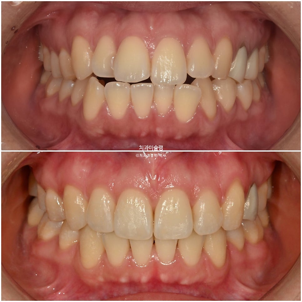 돌출입 발치교정 개방교합 무턱 재교정 인비절라인 입술부전증 치료기간 2년8개월 재제작 2회