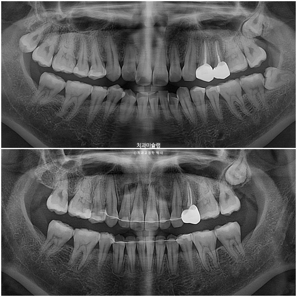 돌출입 발치교정 개방교합 무턱 재교정 인비절라인 입술부전증 치료기간 2년8개월 재제작 2회