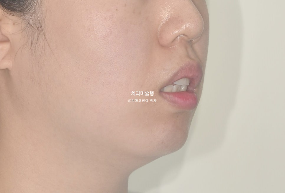 돌출입 발치교정 개방교합 무턱 재교정 인비절라인 입술부전증 치료기간 2년8개월 재제작 2회