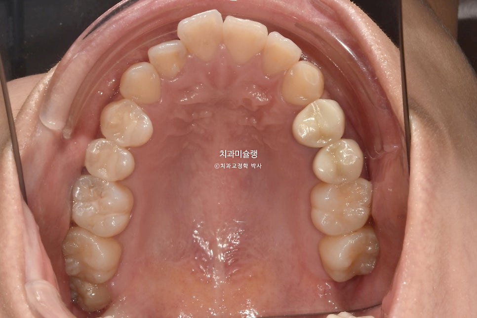 돌출입 발치교정 개방교합 무턱 재교정 인비절라인 입술부전증 치료기간 2년8개월 재제작 2회