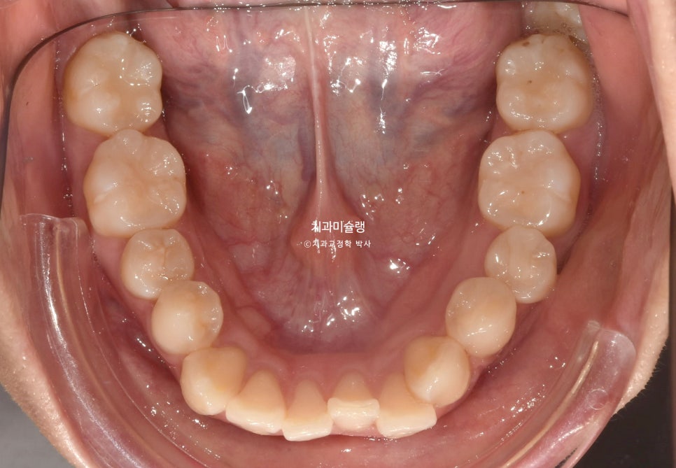 돌출입 발치교정 개방교합 무턱 재교정 인비절라인 입술부전증 치료기간 2년8개월 재제작 2회