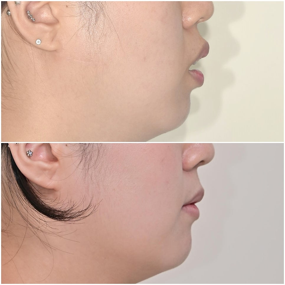 돌출입 발치교정 개방교합 무턱 재교정 인비절라인 입술부전증 치료기간 2년8개월 재제작 2회